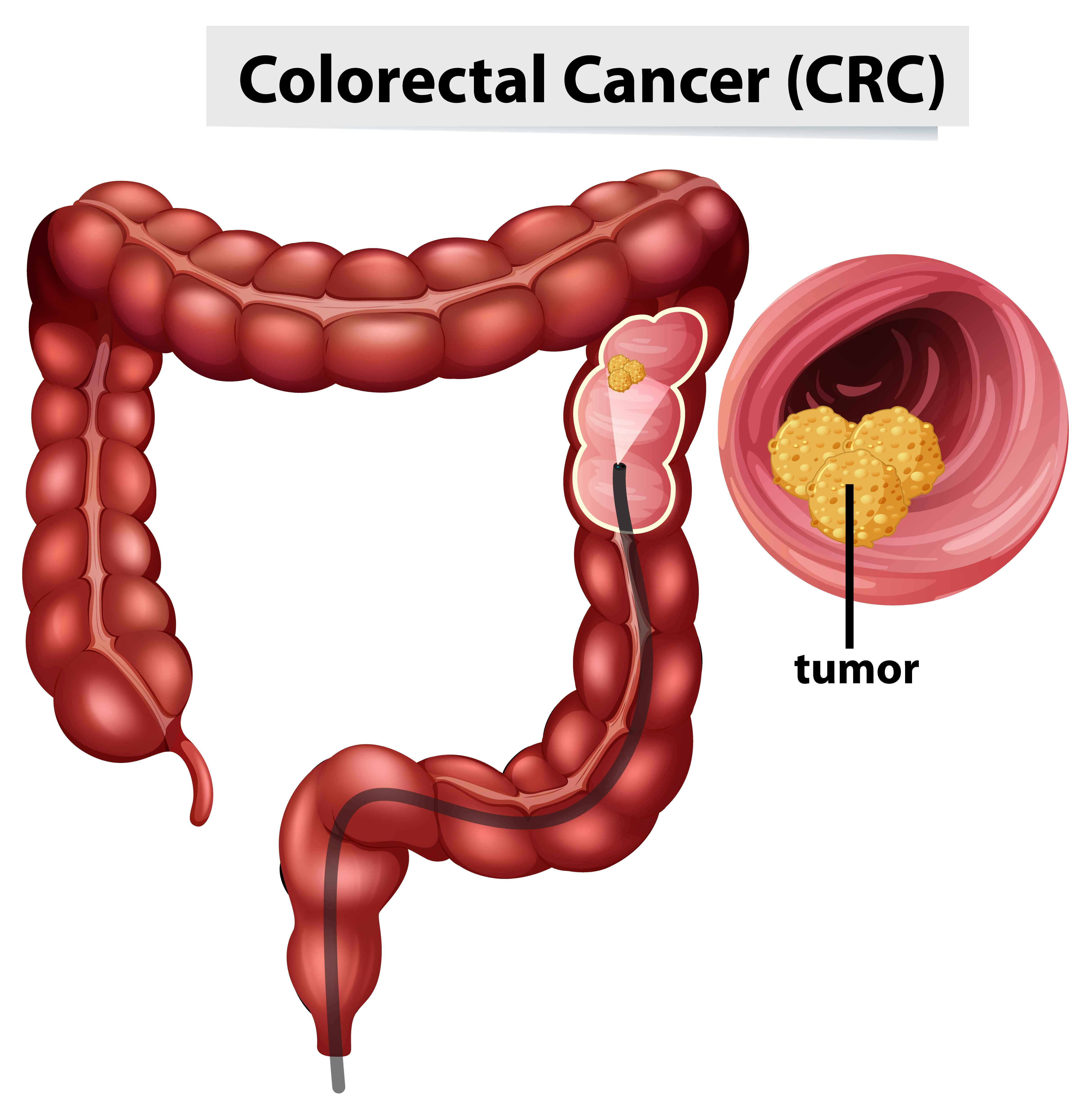 Colorectal Cancer Surgery