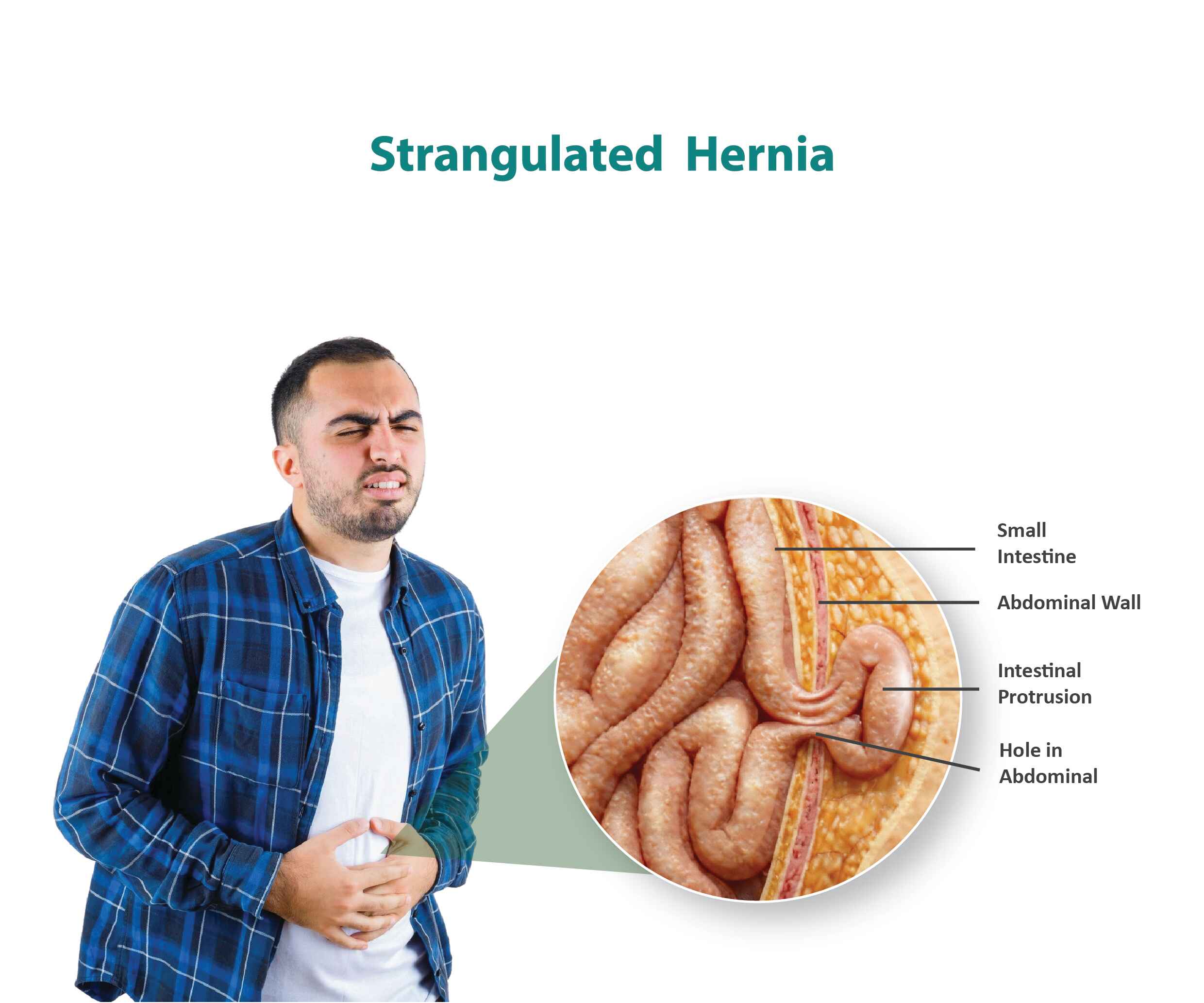 Hernia Surgery